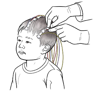 Hands of healthcare provider placing EEG discs on young child's head. Discs are connected to wires.
