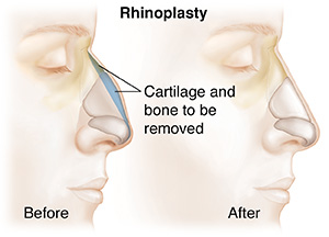 Side view of head showing the before and after of a rhinoplasty. Nose cartilage to be removed highlighted in blue.