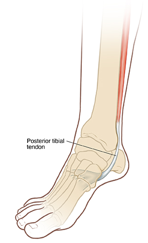 Three-quarter view of lower leg and foot showing bones and posterior tibial tendon. 