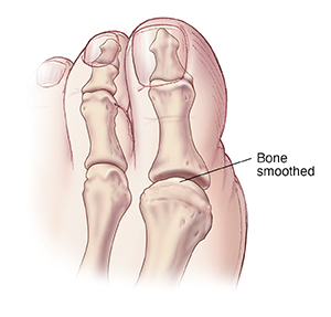 Top view of big toe showing joint after bone smoothed.