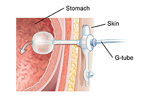 Cross section of body wall showing G-tube inserted into stomach.