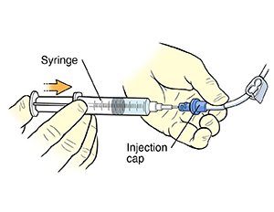 Closeup of gloved hands using syringe to inject solution into catheter injection cap.