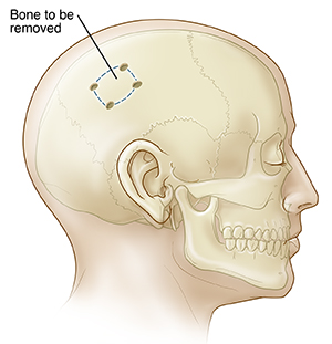 Side view of head with skull showing bone to be removed in craniectomy.