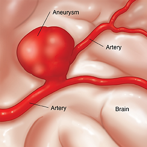 Closeup of brain showing giant aneurysm involving two arteries.