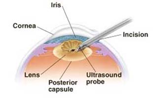 Cross section of front of eye showing instrument performing phacoemulsification.