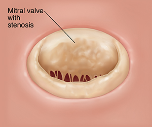 Top view of open mitral valve with stenosis.
