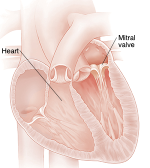 Cross section of heart showing mitral valve prolapse.