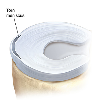 Top view of meniscus showing showing peripheral tear.