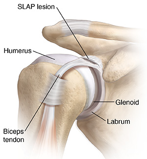 Front view of shoulder joint showing SLAP lesion.