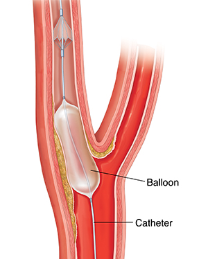 Cross section of carotid artery showing plaque buildup with balloon catheter inserted past plaque.