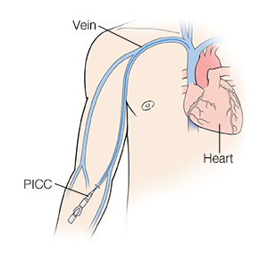 Front view of man showing heart and veins with catheter inserted in forearm (PICC).