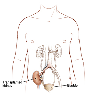 Front view of male body showing urinary tract and transplanted kidney.