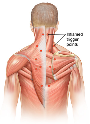 Male torso showing superficial muscles of back. Dots show common locations of trigger points.