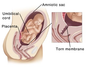 Cross section of pregnant woman's pelvis showing baby in amniotic sac in uterus. Inset shows tear in amniotic sac.