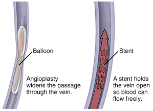 Cross section of vein with balloon inside. Angioplasty widens passage through vein. Cross section of vein with stent inside. Stent holds vein open so blood can flow freely.
