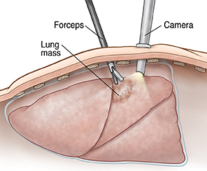 Cross section of body wall showing camera inserted in chest while forceps takes sample from lung mass.