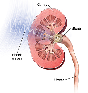 Cross section of kidney showing shock waves breaking up kidney stones.