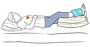 Woman lying down with one leg elevated above level of heart. Bandage and ice pack are on ankle.