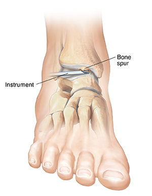 Front view of foot with instrument removing bone spur on ankle bone.
