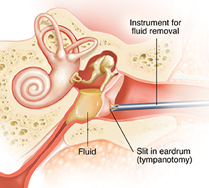 Cross section of child's ear showing fluid in middle ear and inflamed eustachian tube, acute otitis media (AOM). Instrument is suctioning fluid from inner ear.