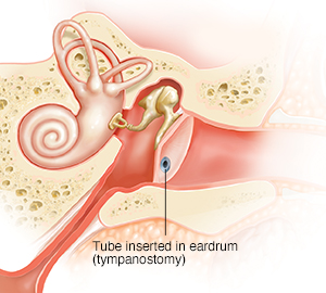 Cross section of child's ear showing fluid in middle ear and inflamed eustachian tube, acute otitis media (AOM). Tube is in eardrum.