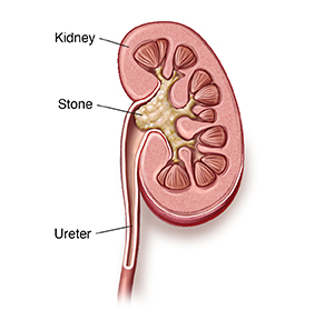 Cross section of kidney and ureter showing large kidney stone.