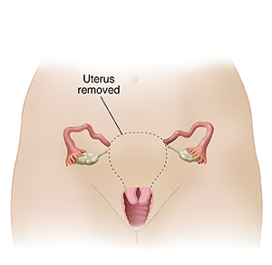 Front view of woman's pelvis showing reproductive tract. Dotted line shows organs removed in supracervical hysterectomy.