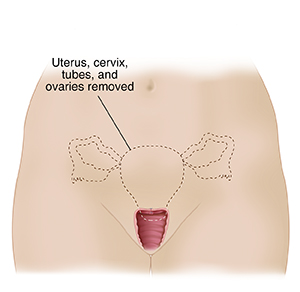 Front view of female pelvis showing reproductive organs and dotted line outlining uterus, cervix , fallopian tubes, and ovaries to show hysterectomy with removal of ovaries.