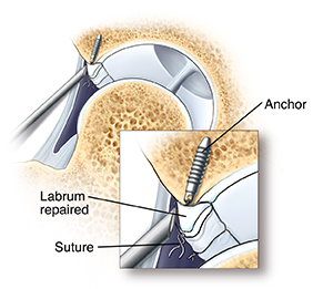 Cross section of hip joint showing arthroscope tip near anchor in bone under labrum. Closeup of arthroscope tip near anchor in bone under labrum. Sutures attached to anchor and tied around labrum hold torn edges together.
