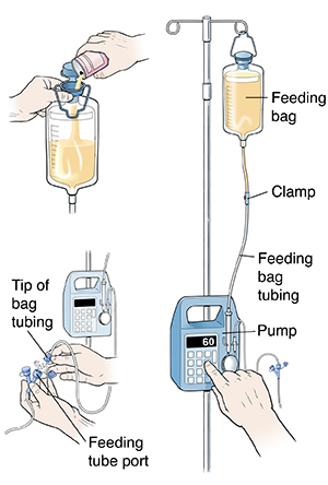 Pump for continuous tube feeding showing feeding bag tubing connecting pump to feeding bag hanging on IV pole. Clamp is in middle of tubing. Inset of hands pouring formula into feeding bag. Closeup of hands inserting tip of bag tubing into feeding tube port.