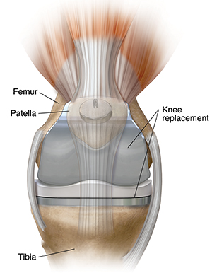 Image of knee including femur, patella, knee replacement, and tibia