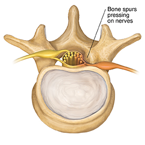 Top view of lumbar vertebra and disk showing bone spur pressing on spinal nerve.