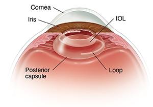 Side view cross section of front of eye showing intraocular lens in posterior capsule.