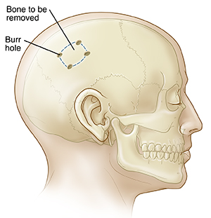 Side view of head with skull showing burr holes for craniotomy.