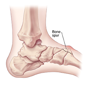 Side view of foot bones showing a midfoot bone spur.