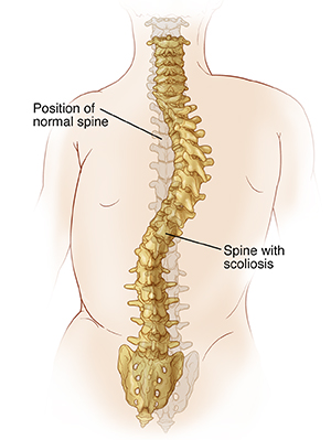 Back view of spine with scoliosis and normal position of spine ghosted in.