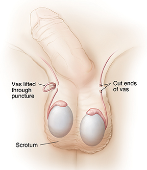 Front view of penis and scrotum showing vas deferens during and after vasectomy.