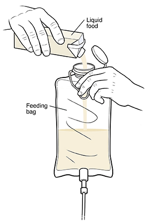 Closeup of hands pouring liquid food into feeding bag.