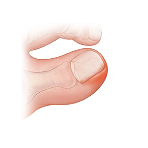 Closeup of toe with ingrown toenail.
