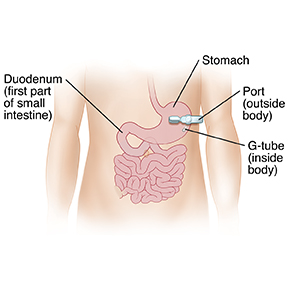 Front view of child's abdomen showing G-tube inserted through body wall into stomach.