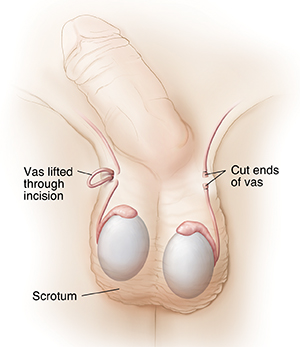 Front view of penis and scrotum showing vas deferens during and after vasectomy.
