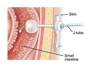 Cross section of body wall showing J-tube inserted into small intestine.