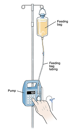 Feeding bag full of liquid food hanging from IV pole. Hand pushing button on pump.