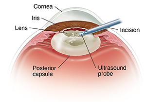 Front view cross section of eye showing instrument removing lens.