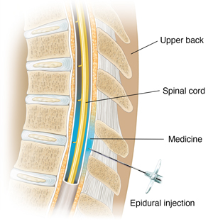 Cross section of thoracic spine with needle inserted just outside sac surrounding spinal cord.