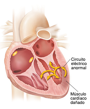 Corte transversal del corazón que muestra taquicardia ventricular.
