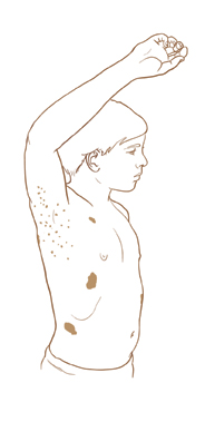 Contorno de un varón adolescente con el brazo derecho en alto, visto de perfil. En la axila se ven pequeñas manchas marrones. Hay tres manchas grandes marrones en el pecho y el abdomen del joven.