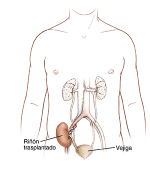 Vista frontal de un cuerpo masculino donde pueden verse las vías urinarias y el riñón trasplantado.