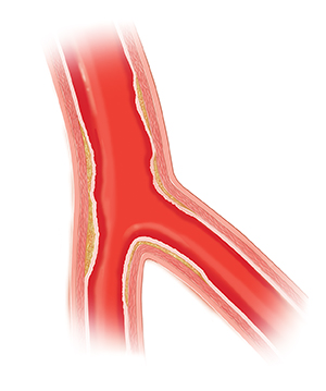 Corte transversal de una arteria con el recubrimiento interior dañado.