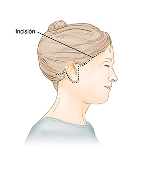 Vista lateral de la cabeza de una mujer mostrando la incisión para una ritidectomía (estiramiento facial)